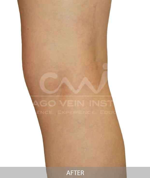 Spider Vein Treatment Chicago Chicago Vein Institute 