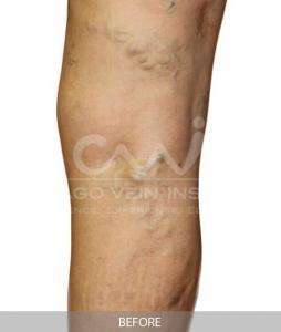 Varicose Vein Removal With EVLT